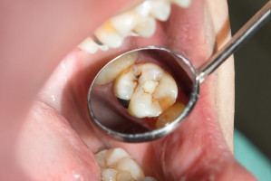 Bioaktywność materiałów - do weryfikacji przez stomatologa