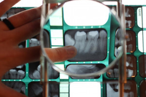 Nowoczesne metody obrazowania pomagają dentyście poznać anatomię i morfologię leczonego zęba (fot. Shutterstock) Pacjentka z trzonowcem o sześciu korzeniach
