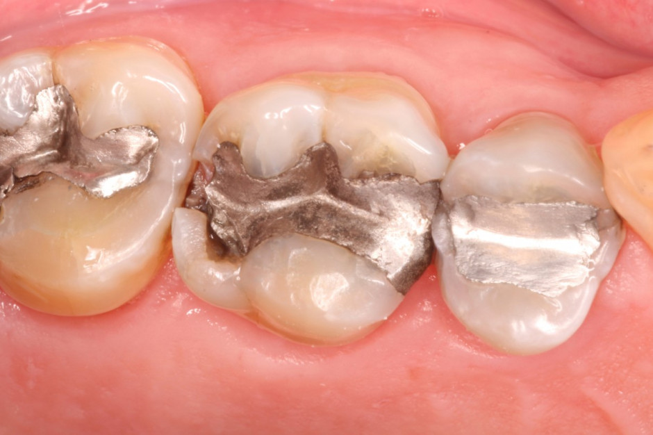 Spór o separatory amalgamatu stomatologicznego (fot. Shutterstock)