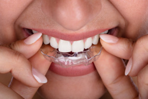 Ortodontyczne leczenie z jednoczesnym wybielaniem
