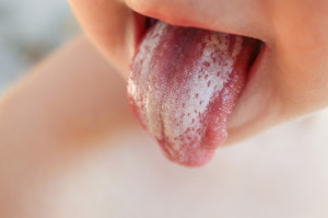 Zmiany wywołane przez Candida albicans (fot. Shutterstock) Co pacjent powinien wiedzieć o kandydozie jamy ustnej