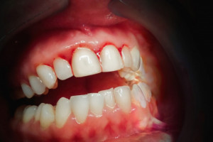 Naukowcy: utrata kości w parodontozie powodowana przez bakterie