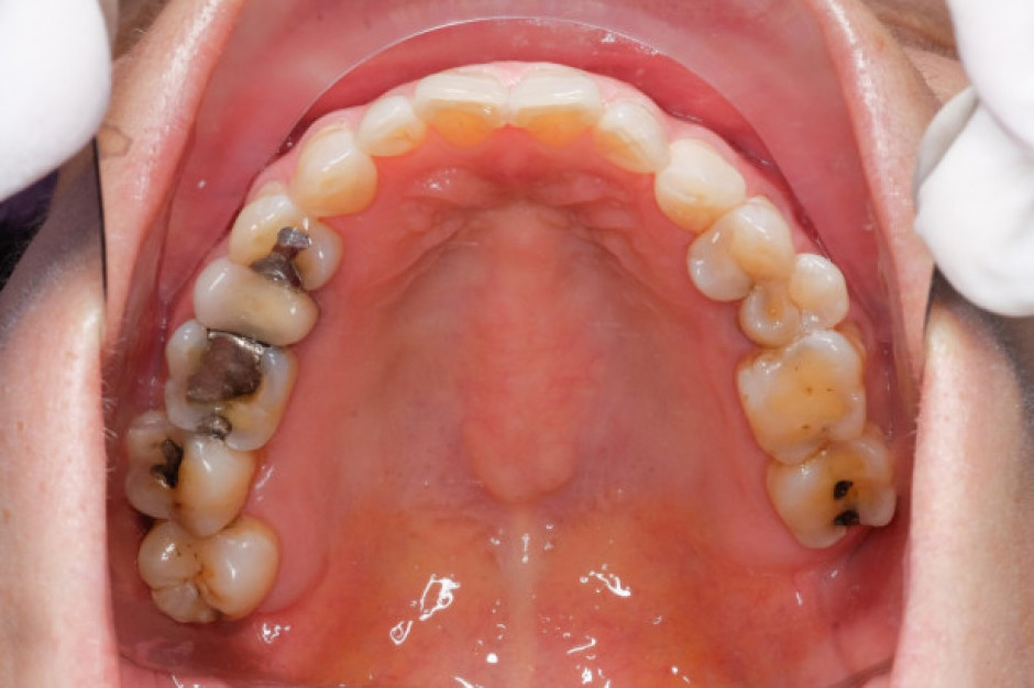 Zasady odchodzenia od amalgamatu stomatologicznego (fot. Shutterstock)