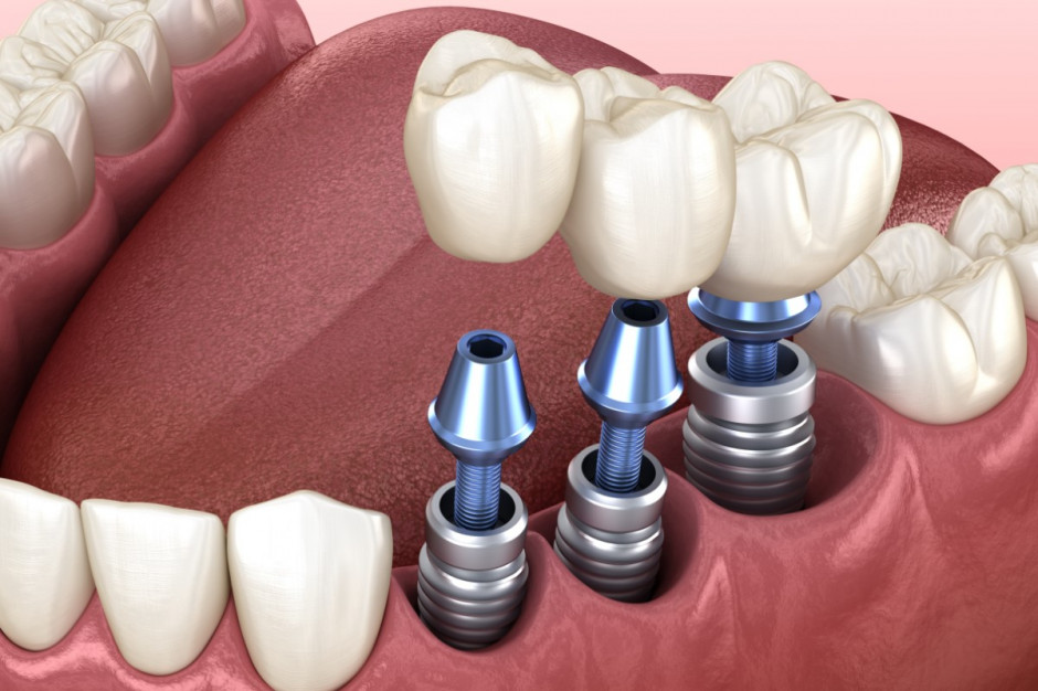 Nieustannie rośnie rynek implantów zębowych (fot. Shutterstock)