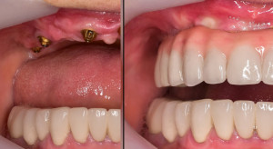 Implanty zębów dla seniorów i nie tylko
