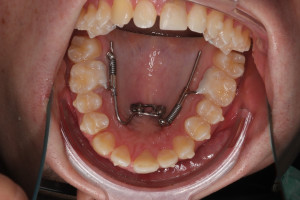 Architektura otwarta w łączonym leczeniu ortodontycznym (case study)