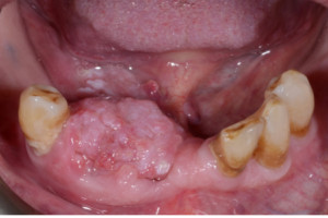 Wademecum profilaktyki nowotworów jamy ustnej