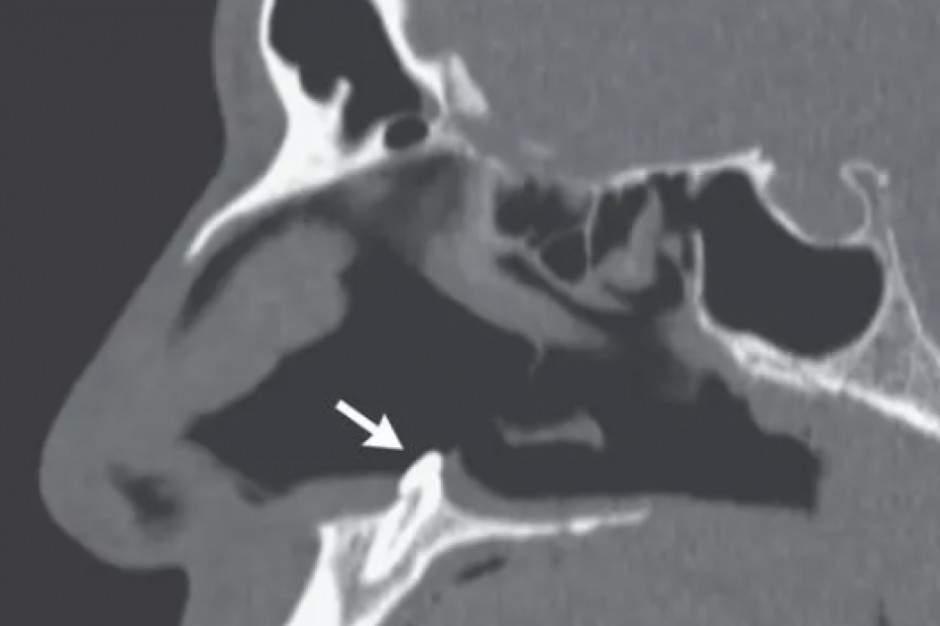 Przypadek ektopowego zęba w prawej komorze nosa
