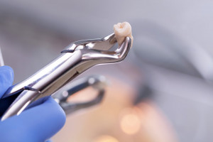Zaskakujące powikłania ekstrakcji ósemki (fot. Shutterstock) Ekstrakcja zęba z powikłaniem w postaci ropnia płuca