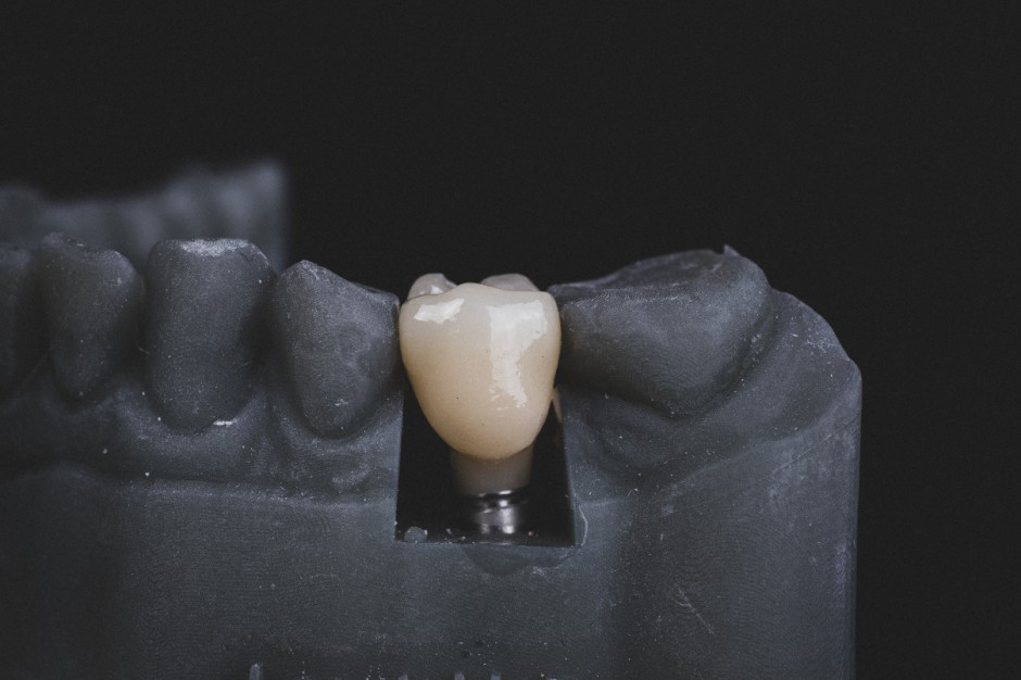 U uczulonych na penicylinę implanty zębowe wypadają cztery razy częściej niż u osób bez alergii (fot. Unsplash)