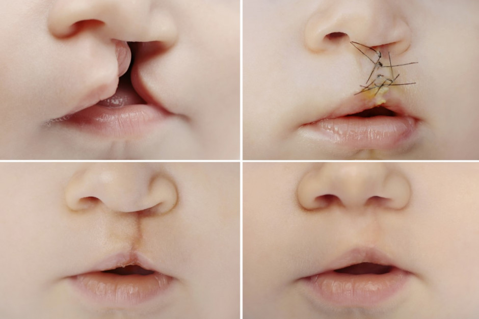 Rozszczep wargi lub podniebienia jest najczęściej występującą wrodzoną wadą rozwojową w obrębie twarzoczaszki (fot. Adobe).