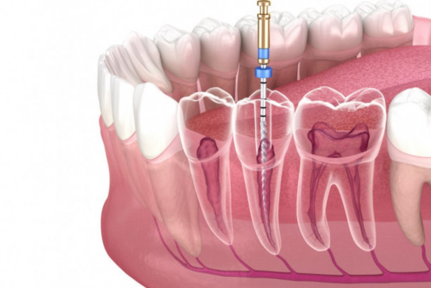 Leczenie kanałowe zęba (fot. Shutterstock) Szkolenie z nowinek w endodoncji