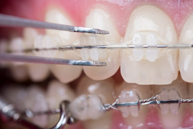 Ortodoncja tylko dla ortodontów? Fot. AdobeStock Ortodoncja: dentysta bez specjalizacji przestępcą?