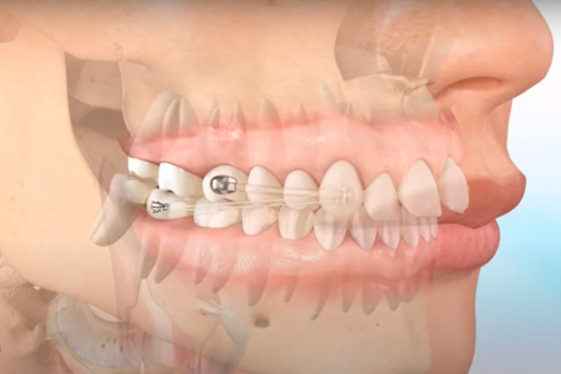 Kolejne podejście w leczeniu ortodontycznym