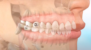 Kolejne podejście w leczeniu ortodontycznym
