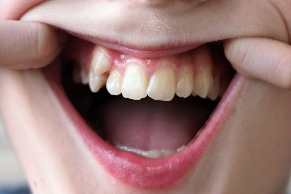 Leczenie ortodontyczne na NFZ powinno być limitowane nie wiekiem ale rodzajem wady Fot. Shutterstock