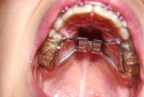 Zdecydowany głos przeciwko uprawianiu ortodoncji bez specjalizacji