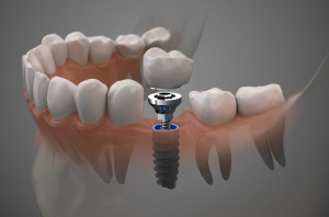 Do wszczepienia implantów trzeba pacjenta troskliwie przygotować Fot. AdobeStock Bezpieczne leczenie implantologiczne