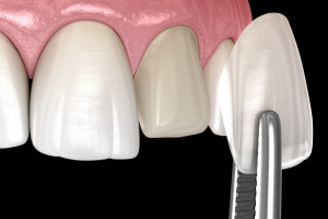 Licówki - dobry wybór dla pacjenta z fluorozą zębów