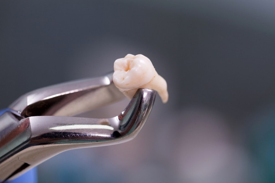 Rzadkie, groźne powikłania ekstrakcji zębów mądrości Fot. AdobeStock