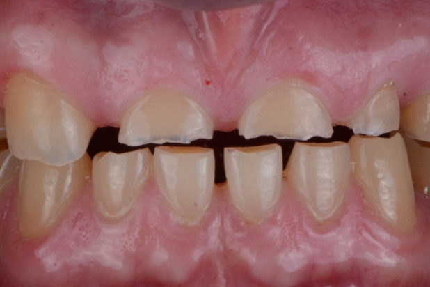 Erozyjne ścieranie zębów Fot. AdobeStock Jak dentyści leczą erozję zębów