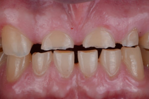 Jak dentyści leczą erozję zębów