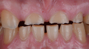 Jak dentyści leczą erozję zębów