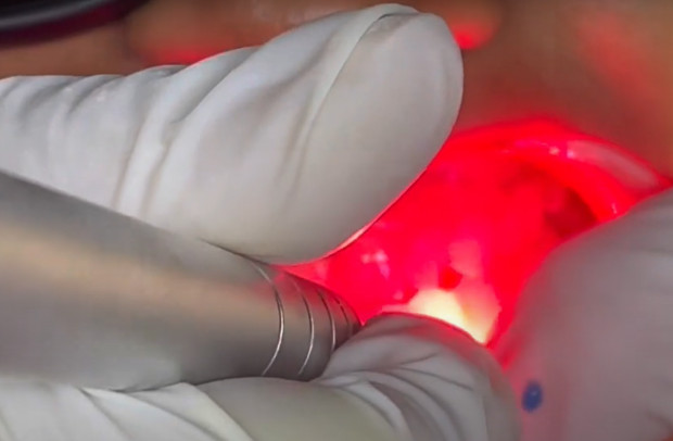 Laser w gabinecie stomatologicznym Fot. Shutterstock Laser w poradni stomatologicznej także na NFZ