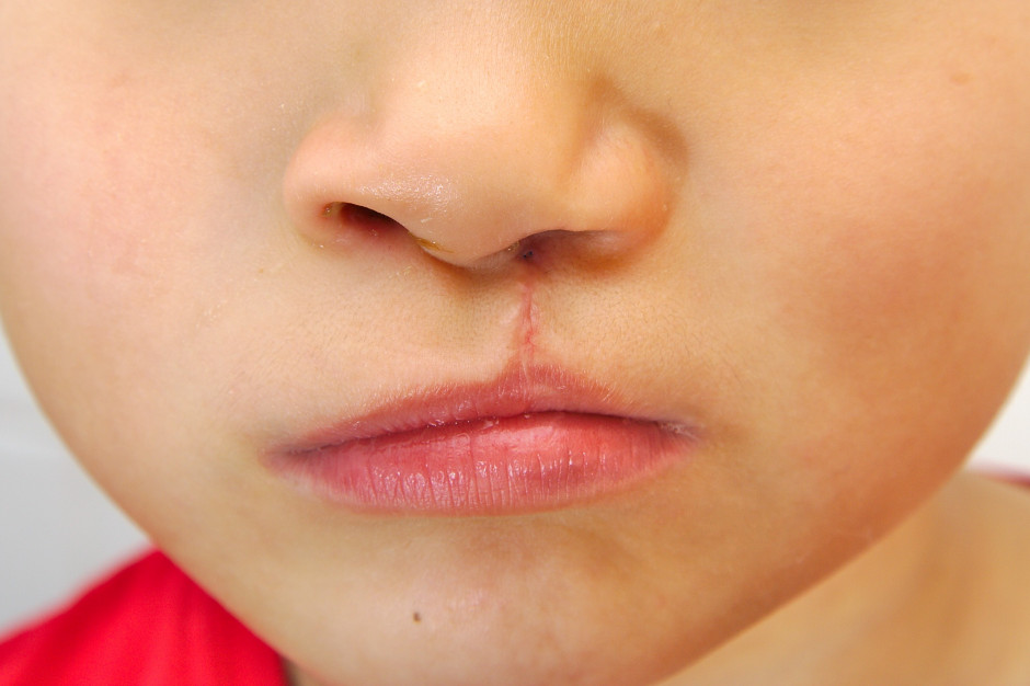 Rozszczep wargi dotyka średnio jedno na 500 dzieci (fot. Shutterstock)