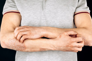 Łuszczycowe zapalenie stawów a choroby jamy ustnej Fot. AdobeStock Łuszczycowe zapalenie stawów a zdrowie jamy ustnej. Jest ścisły związek
