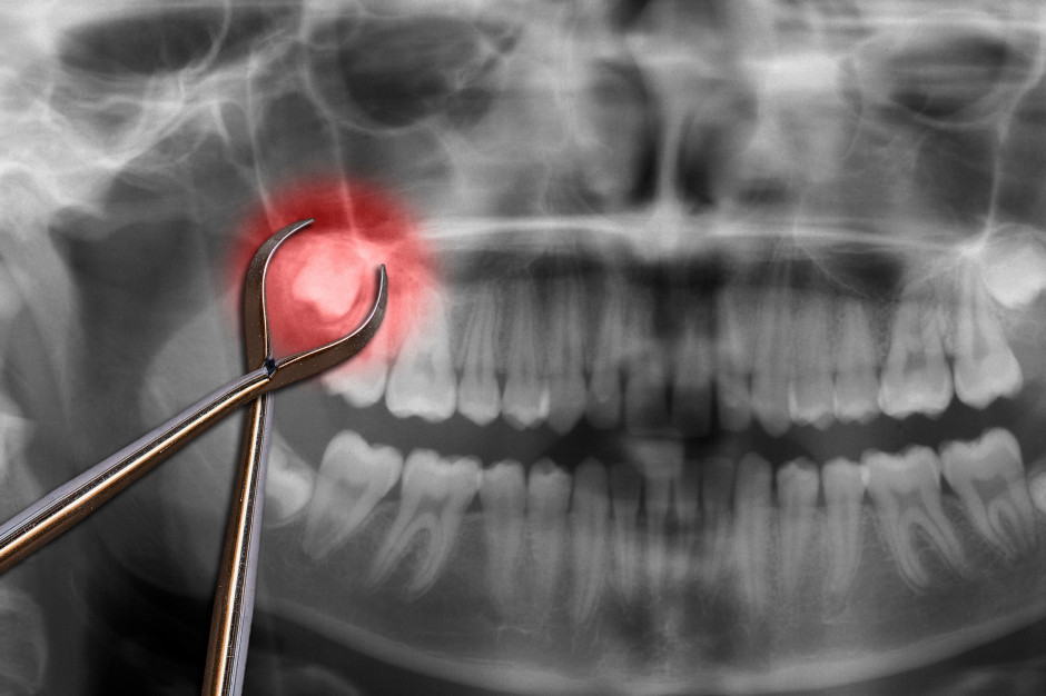 W jakich sytuacjach usuwa się zęby? Fot. AdobeStock