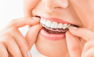 Jakie wypełnienie w zębach bocznych w ramach NFZ?