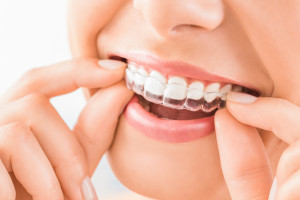 Jak raportować w zębach przednich zaopatrzenie 3-powierzchniowych ubytków? 