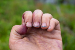Czy nawyk obgryzania paznokci może przynosić korzyści? Dentyści kontra epidemiolodzy