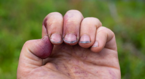 Czy nawyk obgryzania paznokci może przynosić korzyści? Dentyści kontra epidemiolodzy