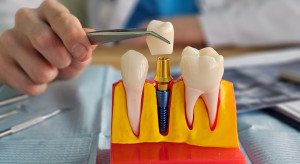 Naukowcy z Wrocławia badają choroby wokół implantów zębowych. To ratunek dla pacjentów